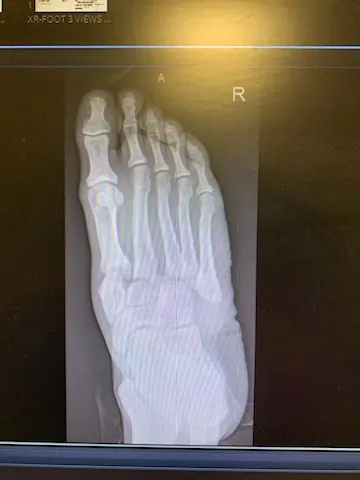charcot foot xray