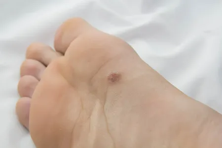 Achilles Lengthening for Diabetic Foot Ulcers: Relief Guide