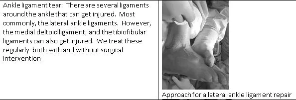 ankle ligament tear