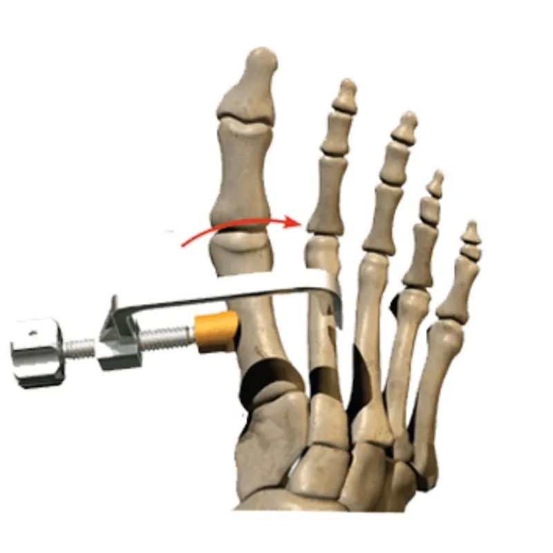 bunion correction surgery at we treat feet podiatry