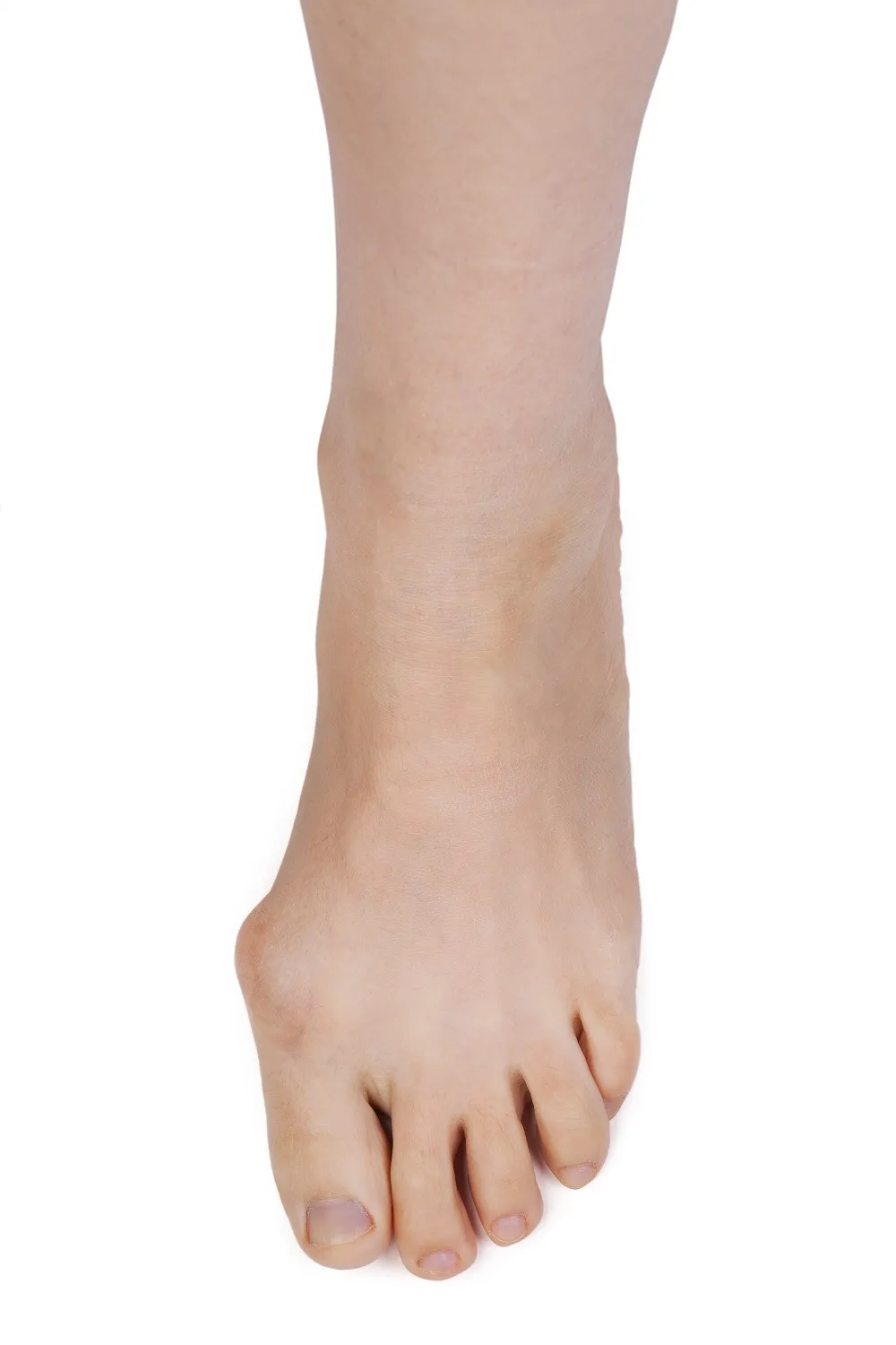 bunion treatment