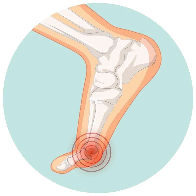 Effective Treatments for Bunions - Common Foot Injury