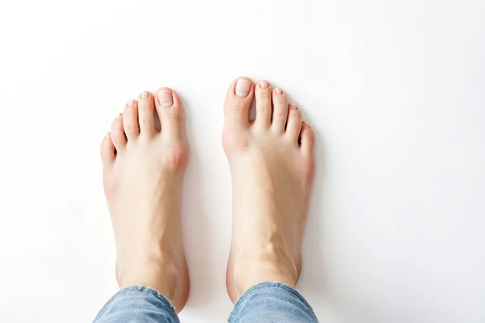 Bunions: Symptoms, Treatment and Prevention