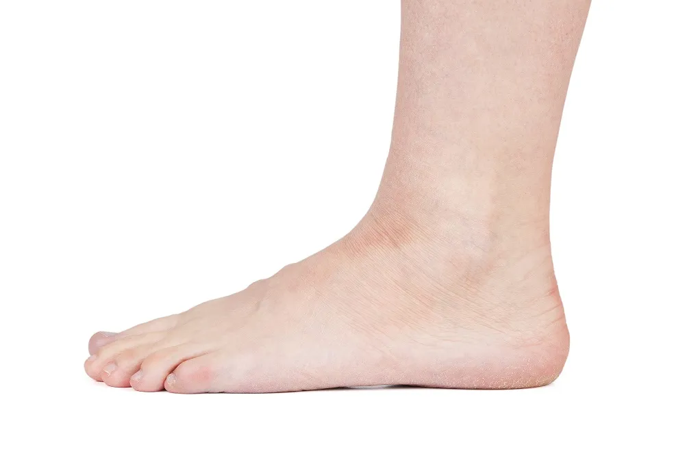Charcot Foot: An Overview of Symptoms and Treatment