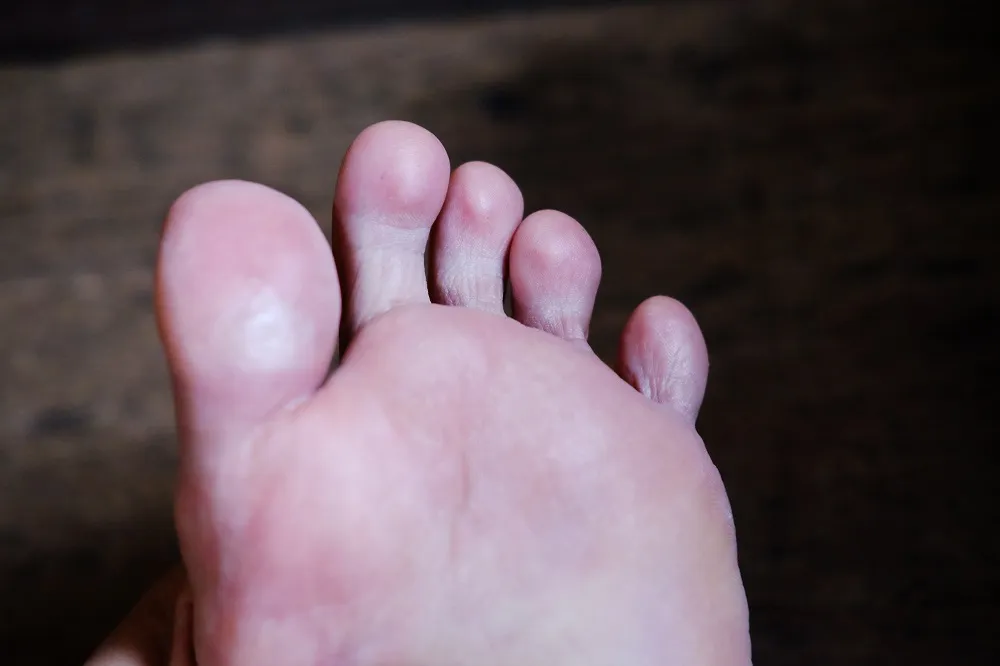 Understanding Corns and Calluses: Causes and Care