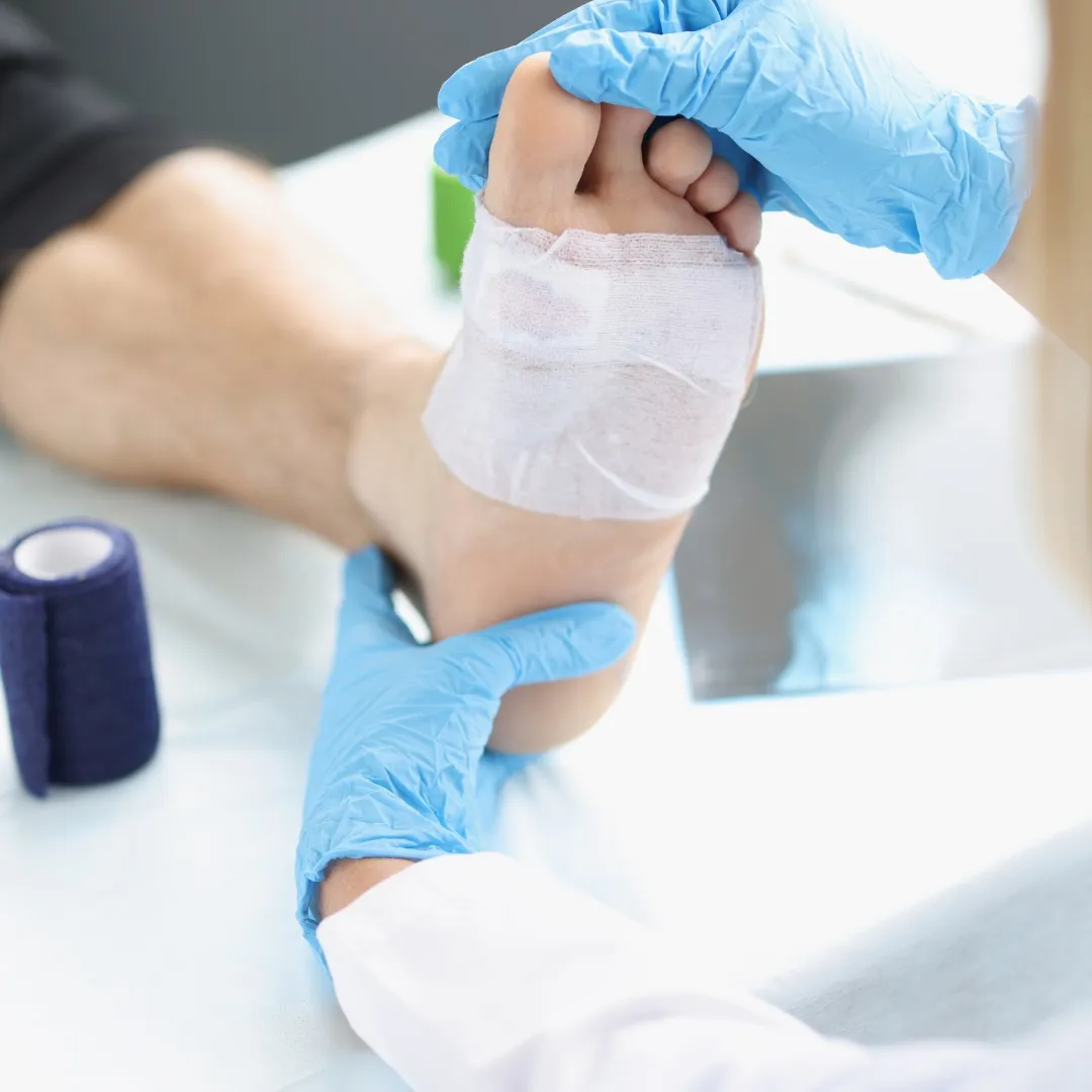 What is a diabetic foot skin graft?