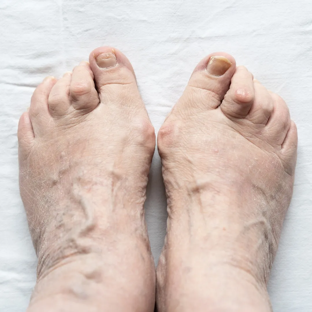 What Are Curled Hammer Toes and How Are They Treated?