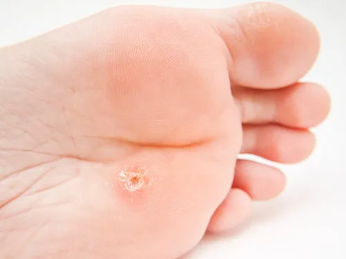 Get Rid of Plantar Warts with Dr. Pizarro at WeTreatFeet