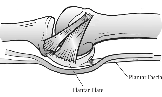 plantar plate surgical repair