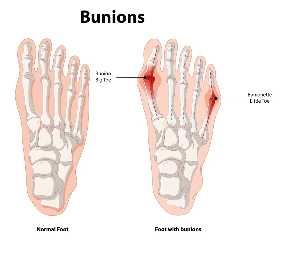 Modern Bunion Surgery: My Honest Take on Trends, Myths, and What Really Works