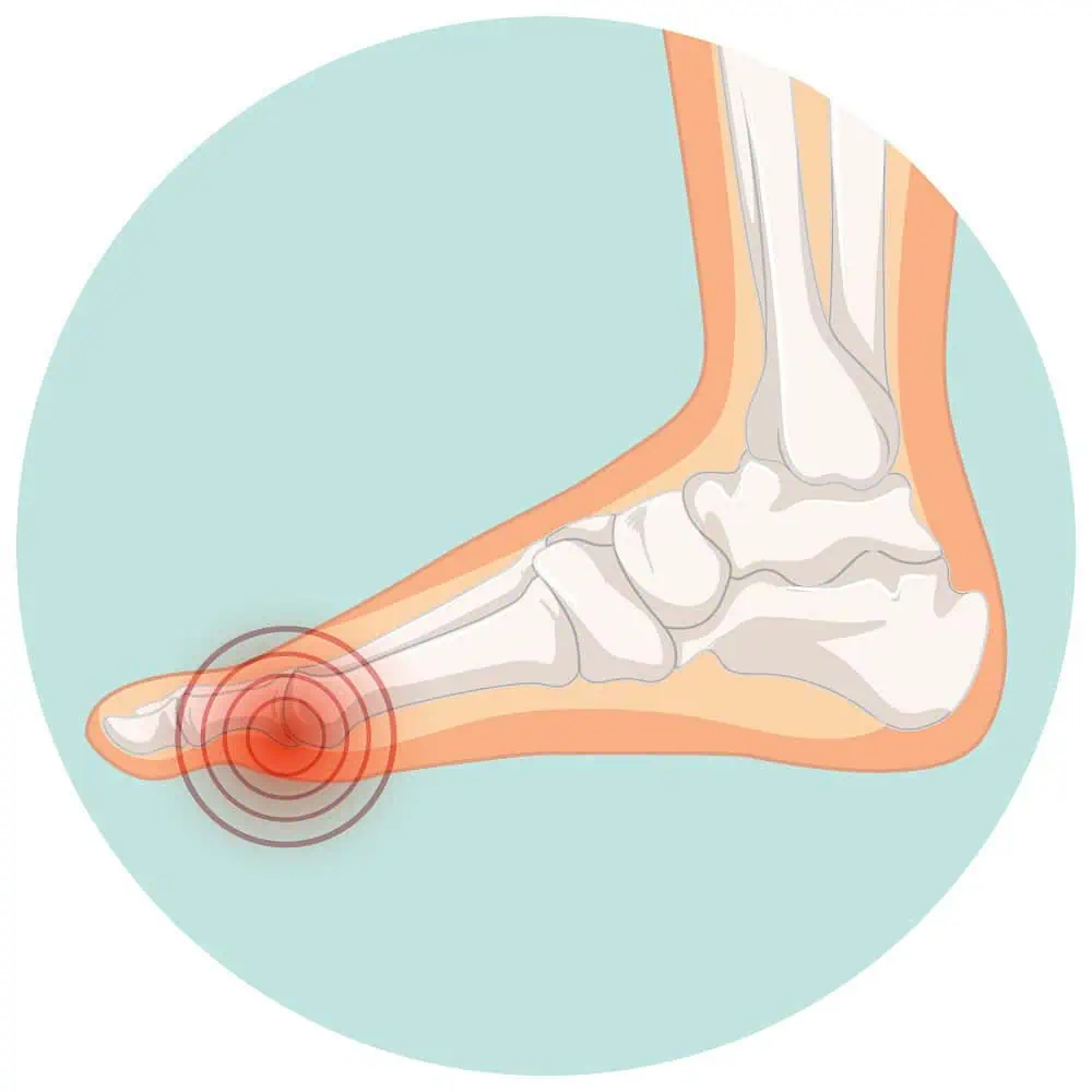 Bunions