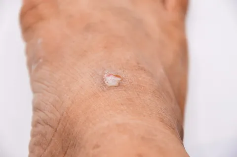 Ulcers