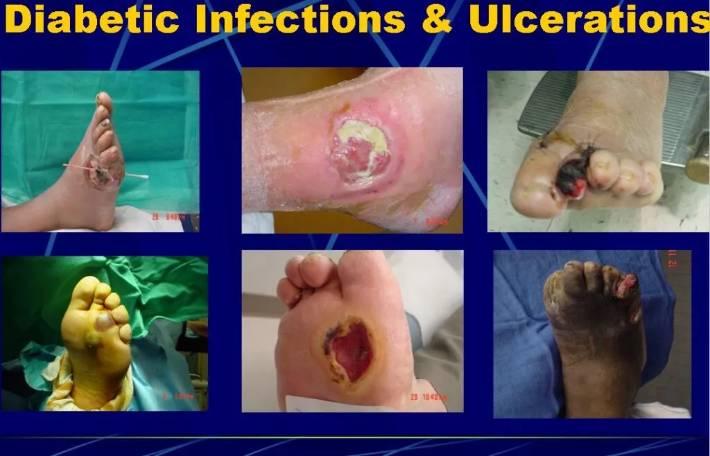 Diabetic foot wound care