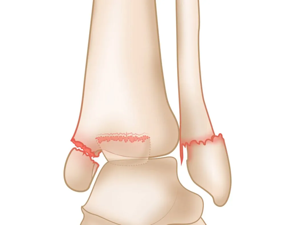 Ankle fracture imaging