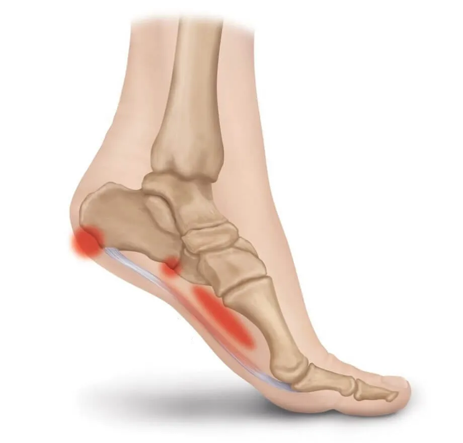 Plantar fasciitis heel-pain anatomy