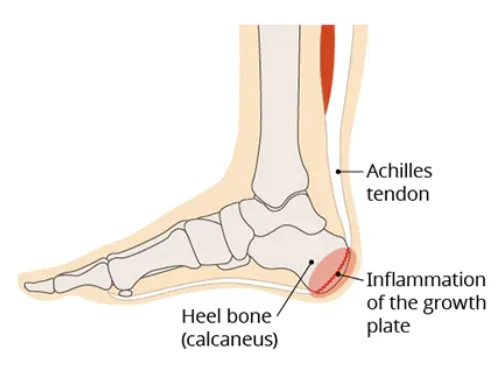 Sever's syndrome heel-pain illustration