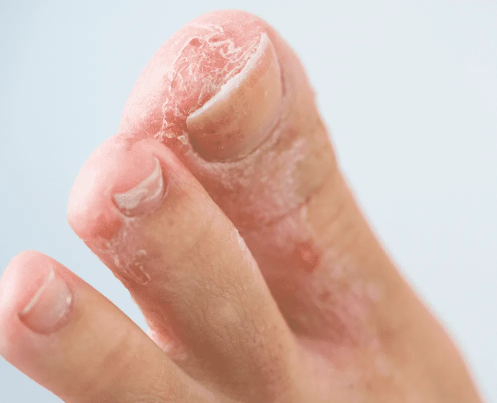 Athlete's foot fungal infection