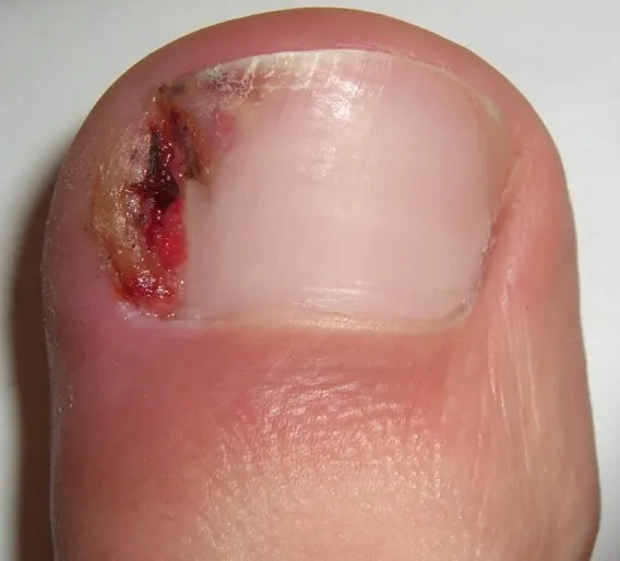 Ingrown toenail close-up