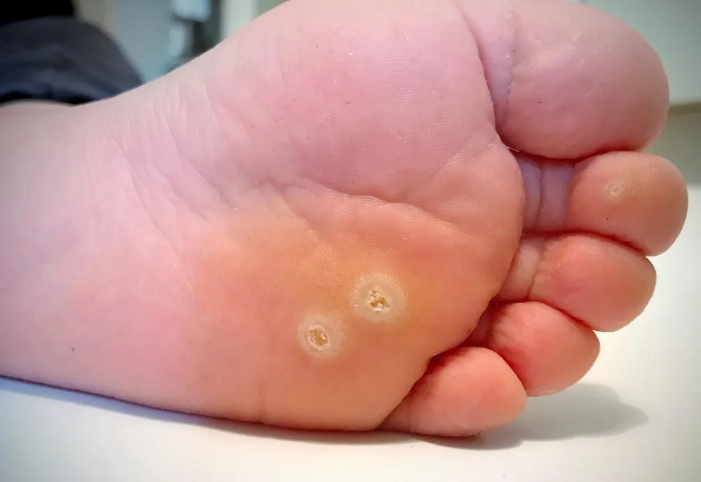 Plantar wart on the sole of the foot