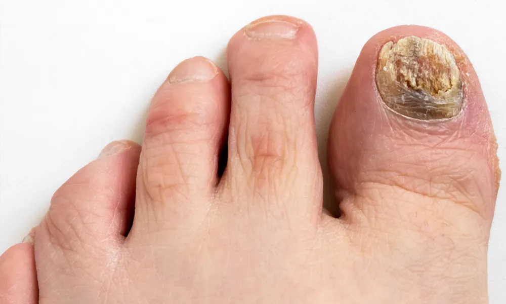 Toenail fungal infection