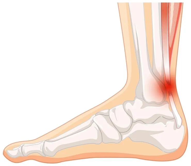 Achilles tendon injury anatomy