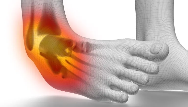 Ankle ligament injury diagram