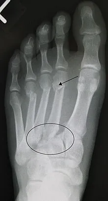 Lisfranc midfoot fracture diagram