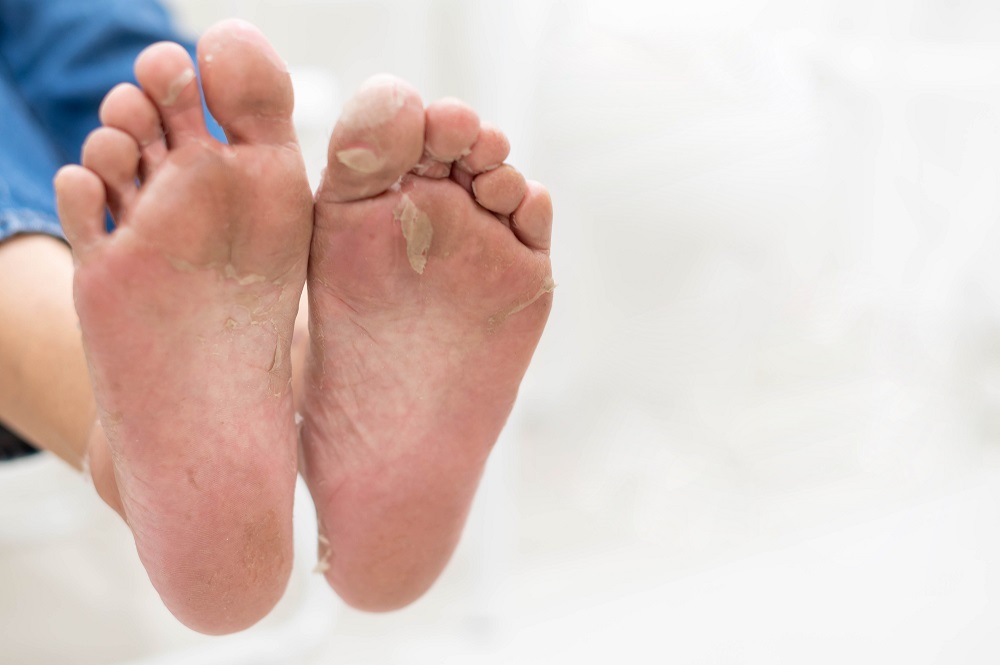 athletes foot tinea pedis