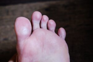 Close-up of a foot blister being cleaned, highlighting the potential use of hydrogen peroxide for disinfection at WeTreatFeet