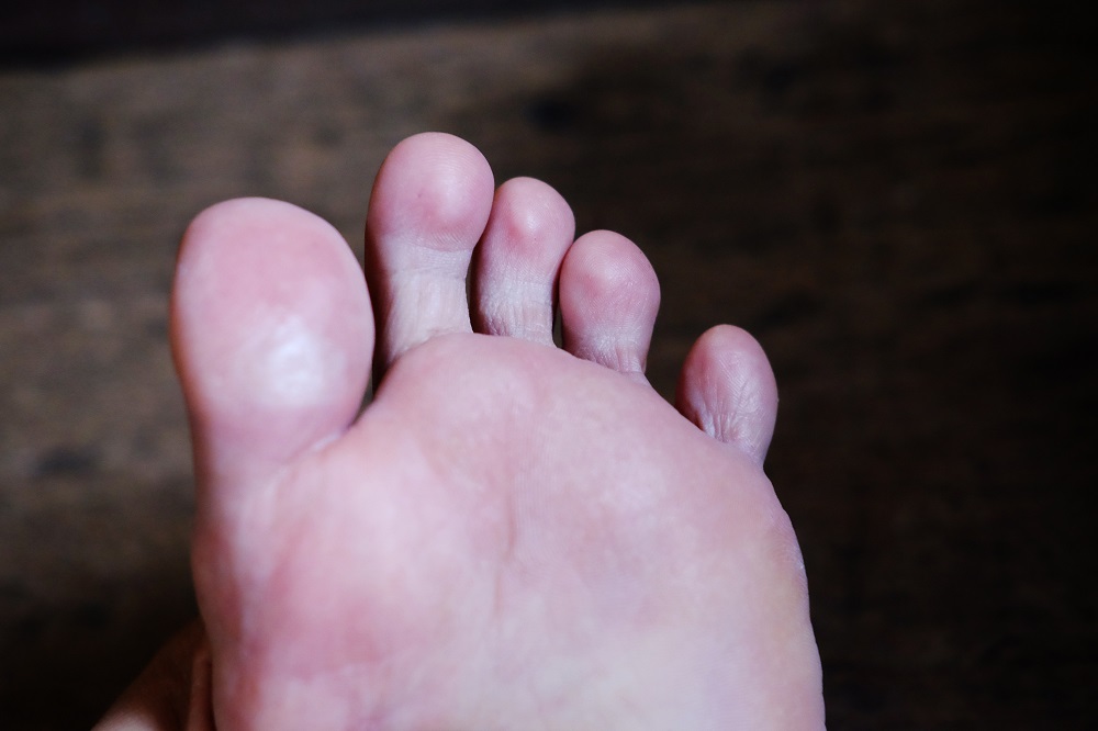 Close-up of a foot blister being cleaned, highlighting the potential use of hydrogen peroxide for disinfection at WeTreatFeet