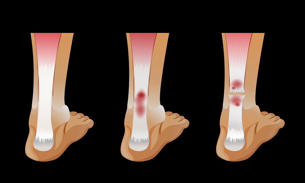 foot tendonitis treatment