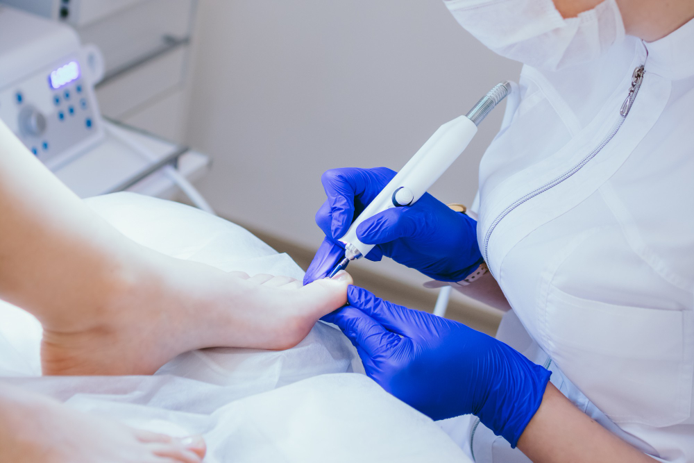 laser treatments ingrown toenails