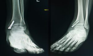 foot fracture