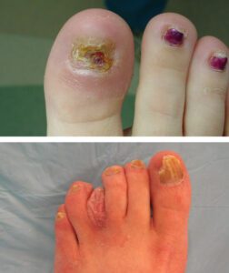 fungal nails treatment in baltimore maryland