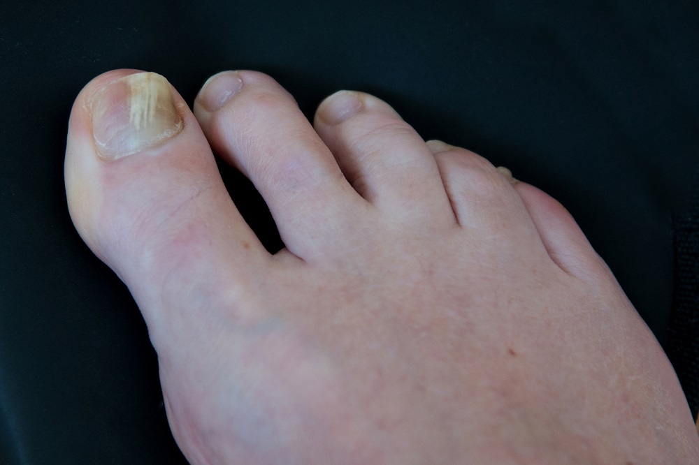 toe injury treatment