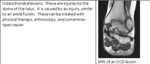 osteochondral lesions injury