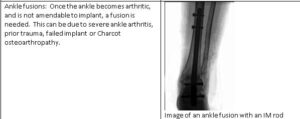 surgically repaired ankle fracture