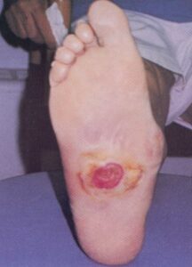 Charcot foot with ulcer