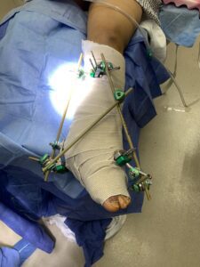 charcot foot surgical treatment