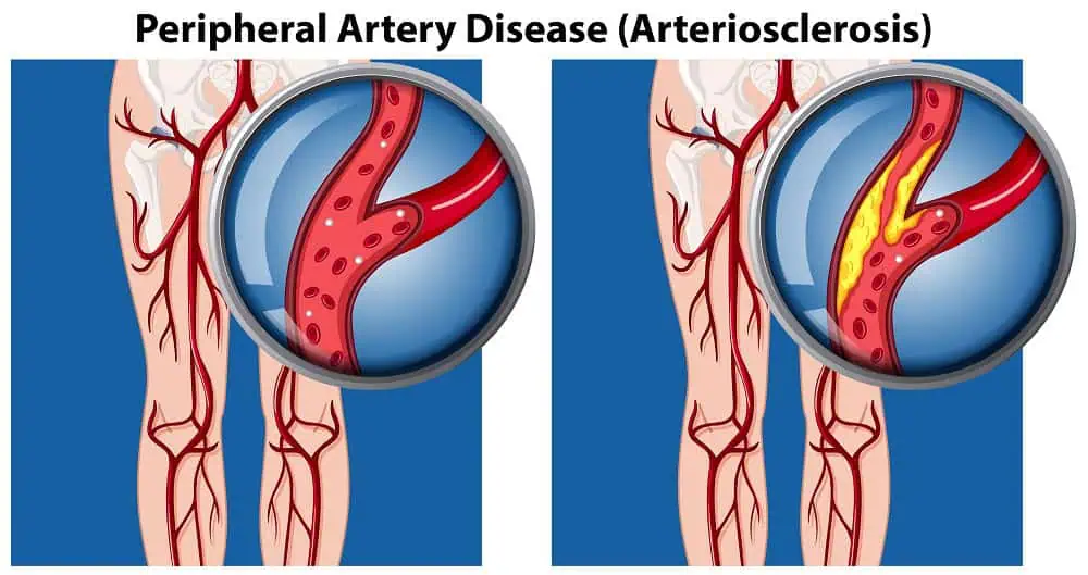 Peripheral Arterial Disease (PAD) Treatment