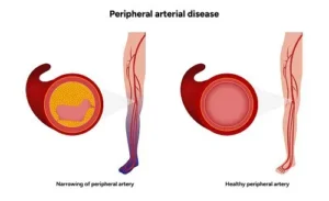 Peripheral Arterial Disease Treatment