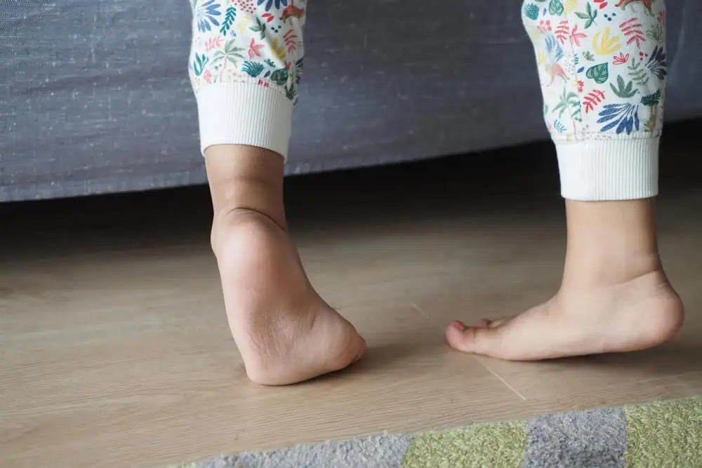 clubfoot correction