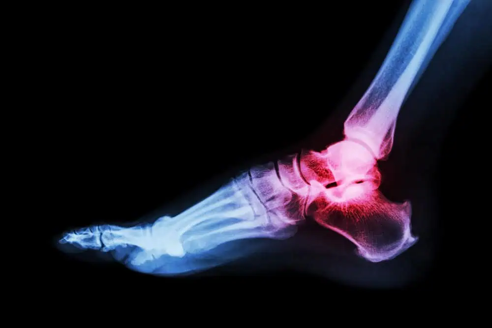 osteoarthritis foot and ankle