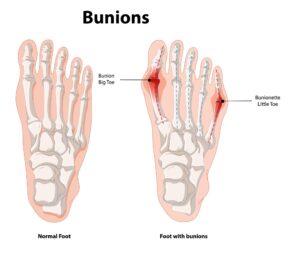 Modern Bunion Surgery bunions causes symptoms and treatment