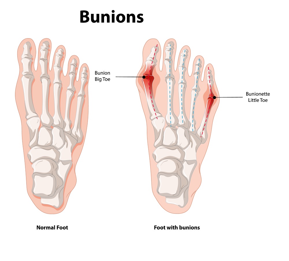 bunions causes symptoms and treatment