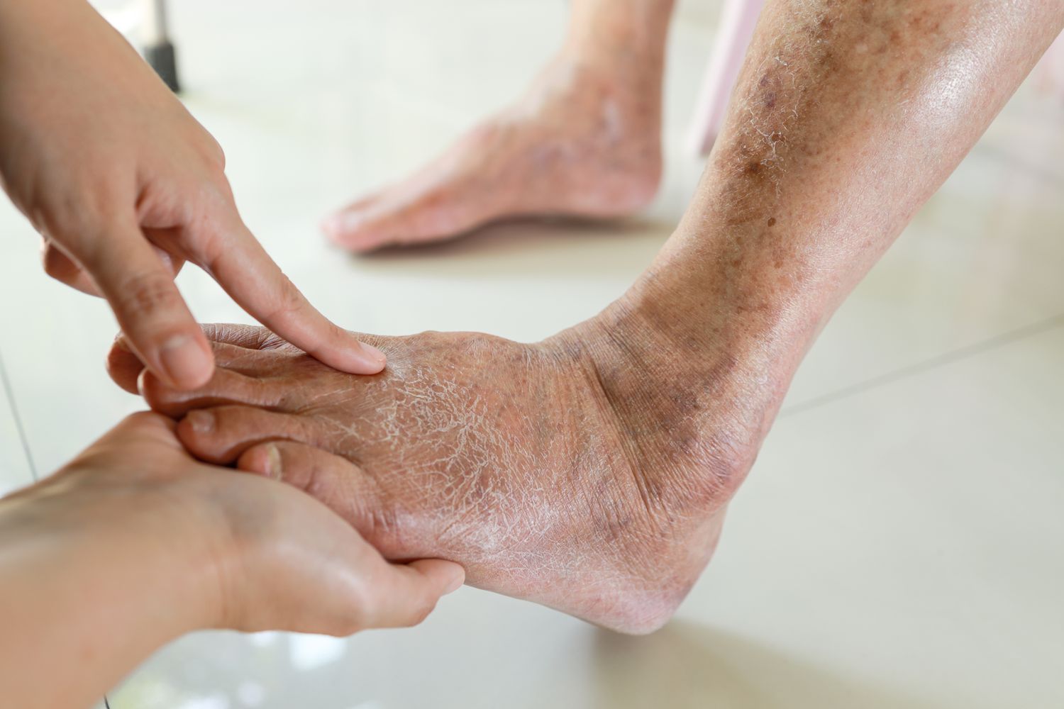 diabetic foot care