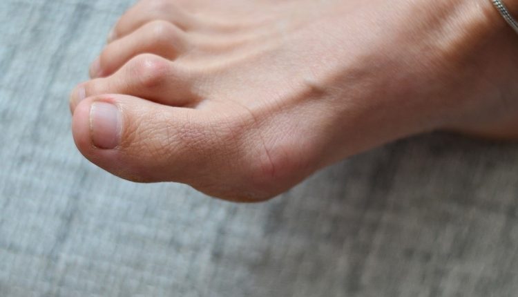 hammertoes deformity