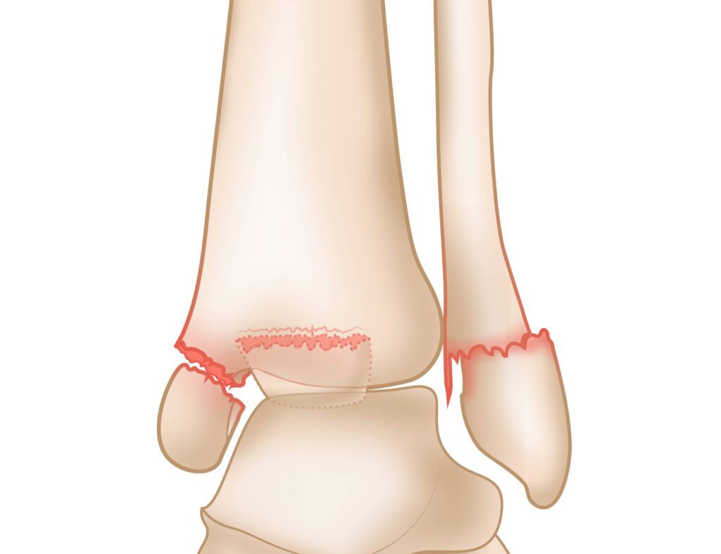 ankle fractures