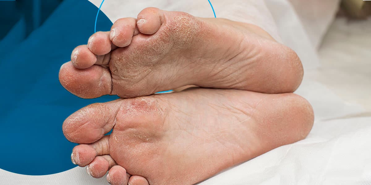 diabetic-foot