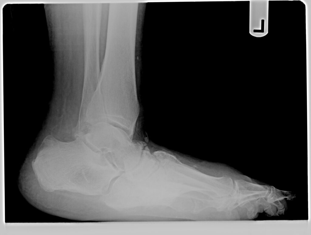 Image illustrating the progression of Charcot Osteoarthropathy, a syndrome in patients who have peripheral neuropathy, or loss of sensation, in the foot and ankle. The image shows the common symptoms such as fractures and dislocations of bones and joints with minimal or no known trauma, severe deformities, including collapse of the midfoot arch and other deformities.